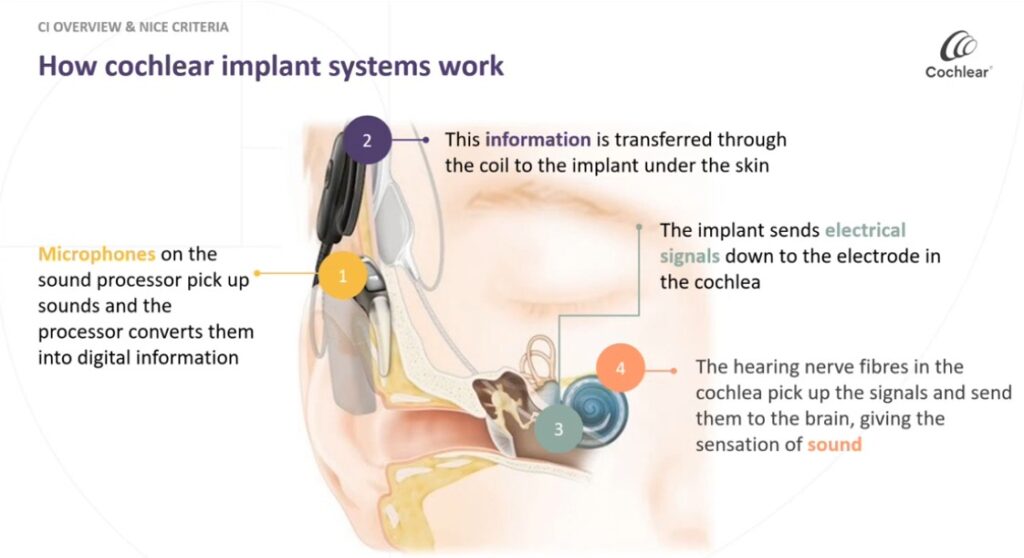 My Cochlear Implant Referral Journey - Bryce Hearing Services, Aberdeen